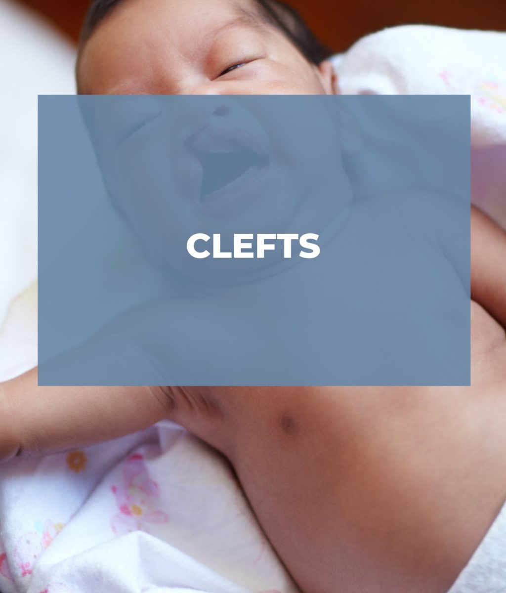 Clefts Clefts